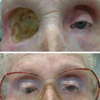 Hallow bulb prosthesis- suction retained 