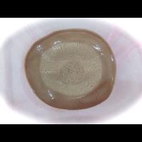 Custom Breast Prosthesis