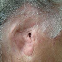 Adhesive retained prosthesis with hearing aid 