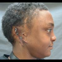 Implant retained prosthesis 