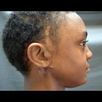 Implant retained prosthesis 