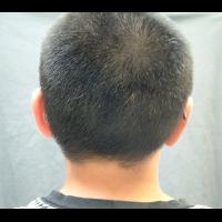 Implant retained prosthesis fitting over microtic remnant 