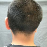 Implant retained prosthesis fitting over microtic remnant 