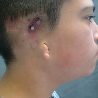 Implant retained prosthesis fitting over microtic remnant 