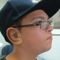 Implant retained prosthesis fitting over microtic remnant 