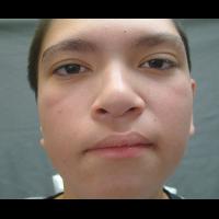 Implant retained prosthesis fitting over microtic remnant 