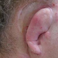 Implant retained prosthesis after removal of undesirable reconstruction 