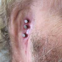 Implant retained prosthesis after removal of undesirable reconstruction 