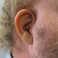 Implant retained prosthesis after removal of undesirable reconstruction 