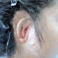 Adhesive prosthesis fitting over undesirable reconstruction