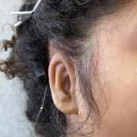 Adhesive prosthesis fitting over undesirable reconstruction