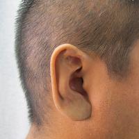 Partial Adhesive retained prosthesis fitting over existing anatomy