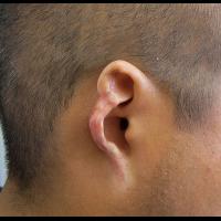 Partial Adhesive retained prosthesis fitting over existing anatomy