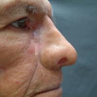 Adhesive retained prosthesis 