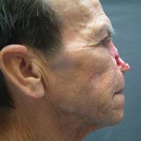 Adhesive retained prosthesis 