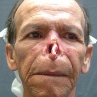 Adhesive retained prosthesis 