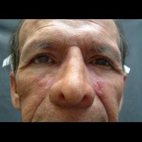 Adhesive retained prosthesis 