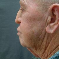 Adhesive retained prosthesis