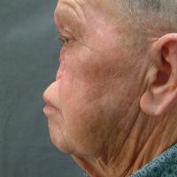 Adhesive retained prosthesis