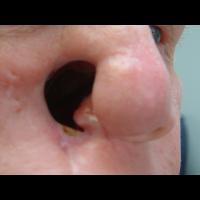 Partial Adhesive retained prosthesis 