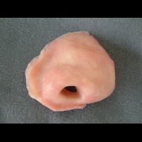 Partial Adhesive retained prosthesis 