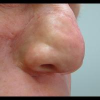 Partial Adhesive retained prosthesis 